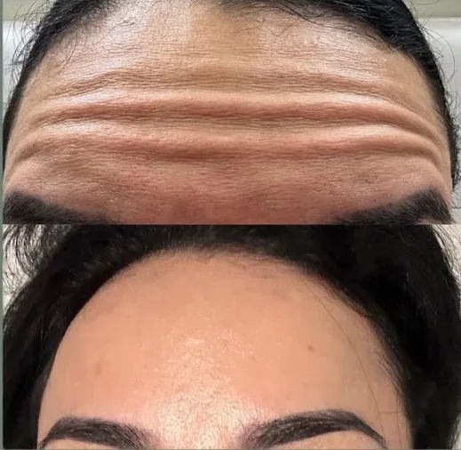 Forehead tox before and after