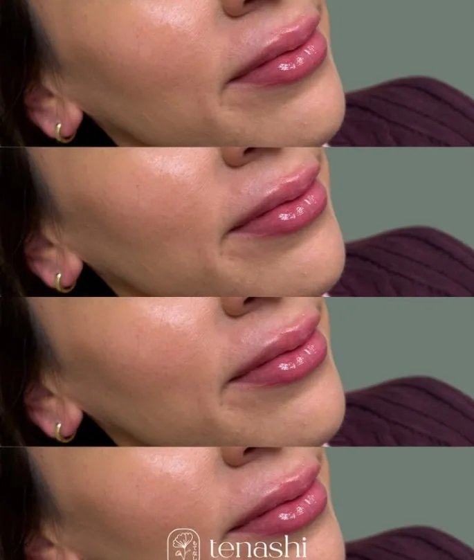 Lip filler progression