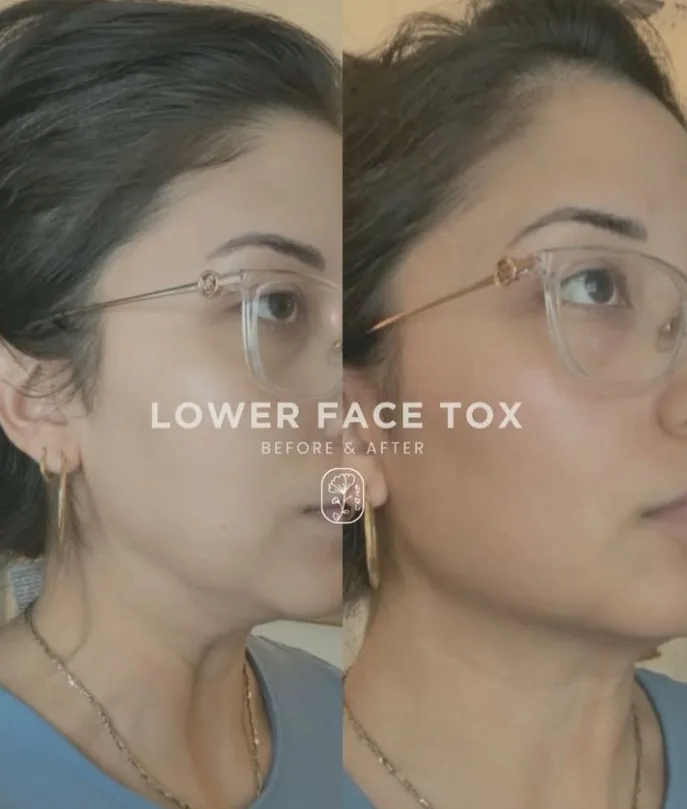 Lower face tox before and after