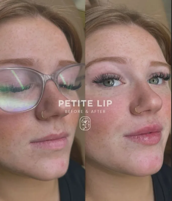 Petite lip filler before and after