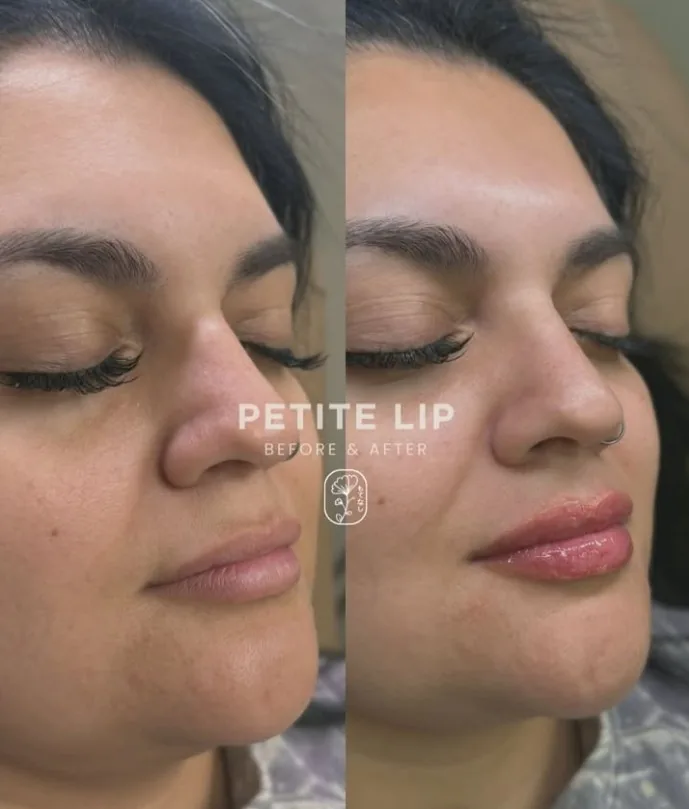 Petite lip filler before and after