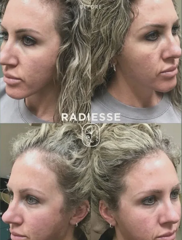 Radiesse before and after, side profile
