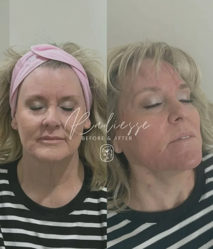 Radiesse before and after