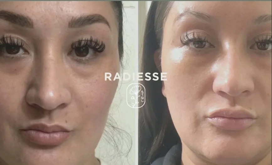 Radiesse before and after, front view