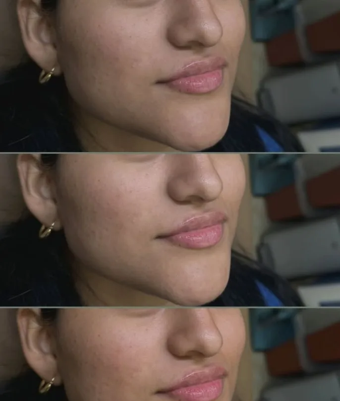 Skin rejuvenation progression